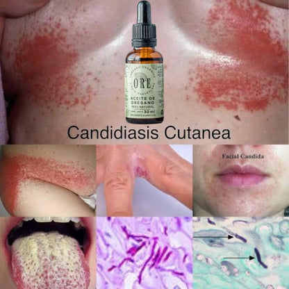 ACEITE DE OREGANO ORE ™ ⭐⭐⭐⭐⭐ ELIMINA LA SINUSITIS, ALERGIAS, RINITIS Y HONGO CANDIDA